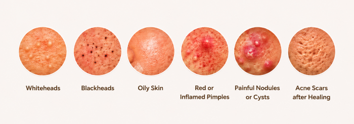 Symptoms of Acne - Ameya Skin Clinic