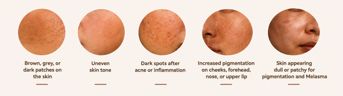Symptoms of Pigmentation & Melasma - Ameya Skin Clinic